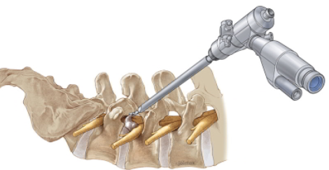 Spine Surgery